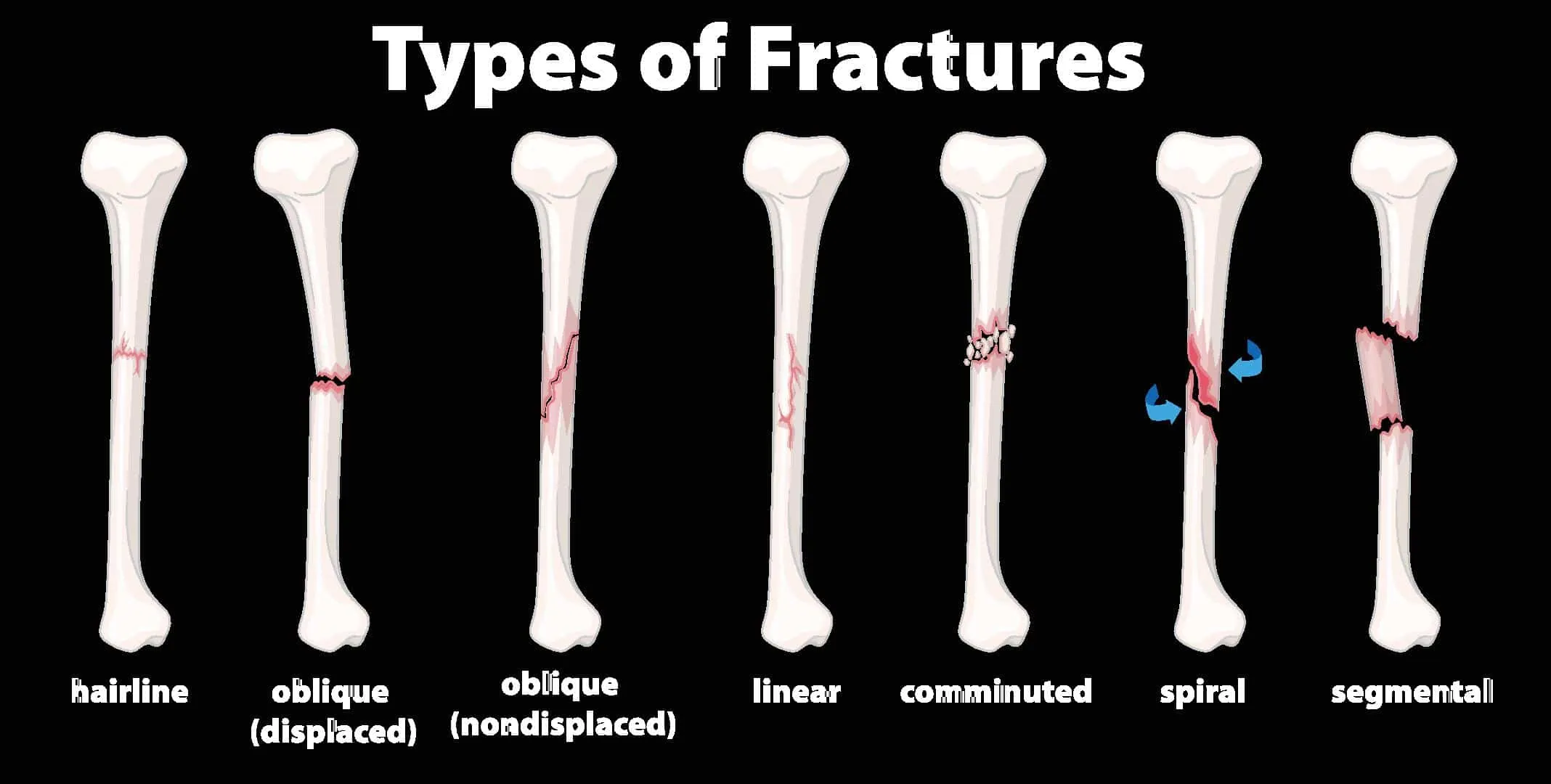 Bone fractures